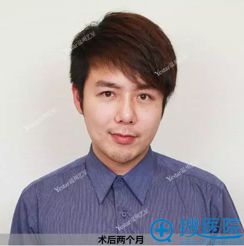术后两个月秒变魅力型男 术后两个月秒变魅力型男