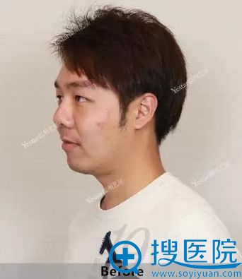 整形前侧面照片 整形前侧面照片