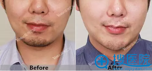垫下巴细节前后对比图 垫下巴细节前后对比图