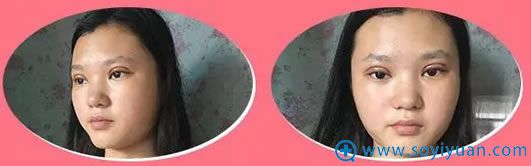 �ڹ���������˫��Ƥ���۽�����һ����
