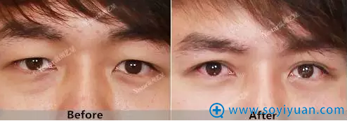 双眼皮细节前后对比 双眼皮细节前后对比