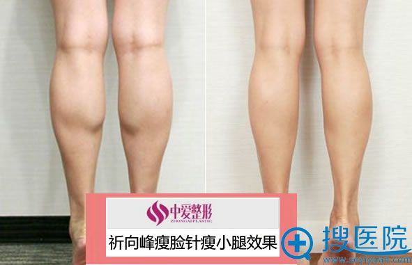 <!--<i data=20240710 data-id=12374></i>-->瘦小腿案例图 <!--<i data=20240710 data-id=12374></i>-->瘦小腿案例图