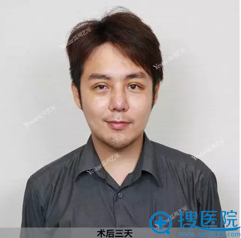 术后三天恢复效果 术后三天恢复效果