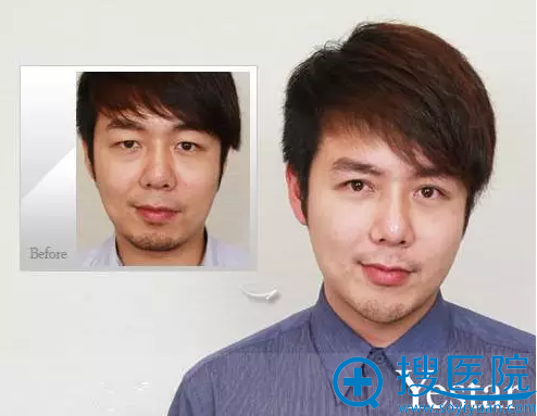 【案例】温州艺星整形双眼皮+祛眼袋+垫下巴让他从大叔变型男