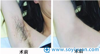 腋毛 脱毛对比图 腋毛 脱毛对比图