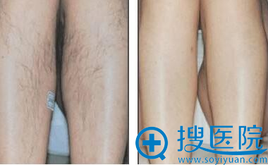 腿毛 脱毛对比图 腿毛 脱毛对比图