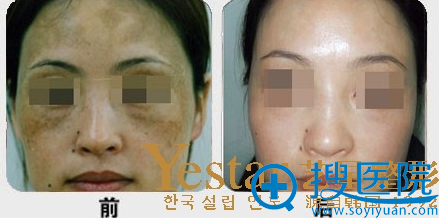 上海Yestar艺星激光去色素沉着案例对比 上海Yestar艺星激光去色素沉着案例对比
