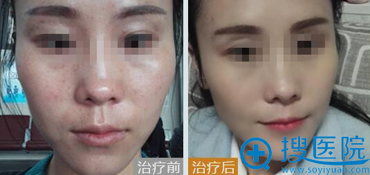 中翰激光祛斑 中翰激光祛斑