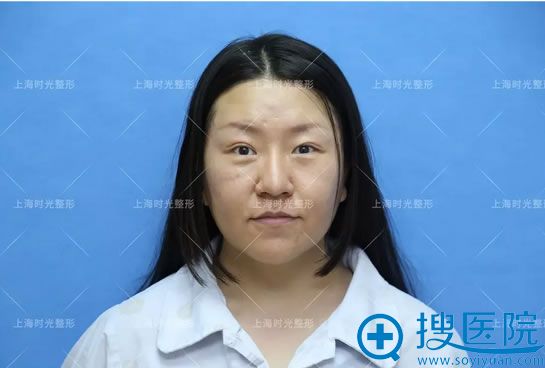 【亲身经历】在上海时光整形找许黎平做面部吸脂真实案例过程图
