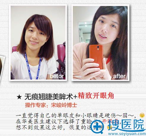 洛阳华美宋峻岭博士双眼皮案例 洛阳华美宋峻岭博士双眼皮案例