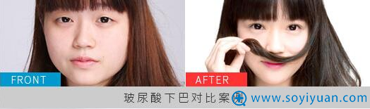 玻尿酸下巴对比图 玻尿酸下巴对比图