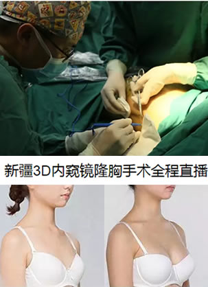 新疆华美整形医院王超杰主任3D内窥镜隆胸手术过程直播