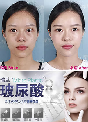 看我在南宁东方做玻尿酸丰苹果肌+太阳穴+泪沟恢复效果怎么样?