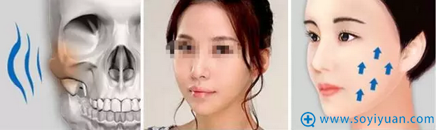 首尔丽格颧骨缩小手术的优势 首尔丽格颧骨缩小手术的优势