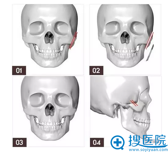 颧骨内缩手术方法 颧骨内缩手术方法