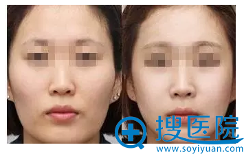 颧骨缩小手术案例 颧骨缩小手术案例