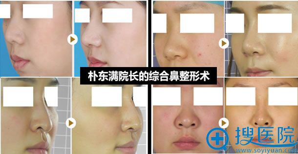 朴东满鼻综合整形手术案例图 朴东满鼻综合整形手术案例图