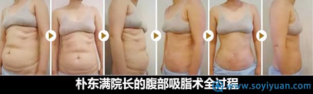 朴东满腰腹部吸脂手术过程图 朴东满腰腹部吸脂手术过程图
