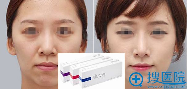 昆明美伊莱艾莉薇玻尿酸案例 昆明美伊莱艾莉薇玻尿酸案例