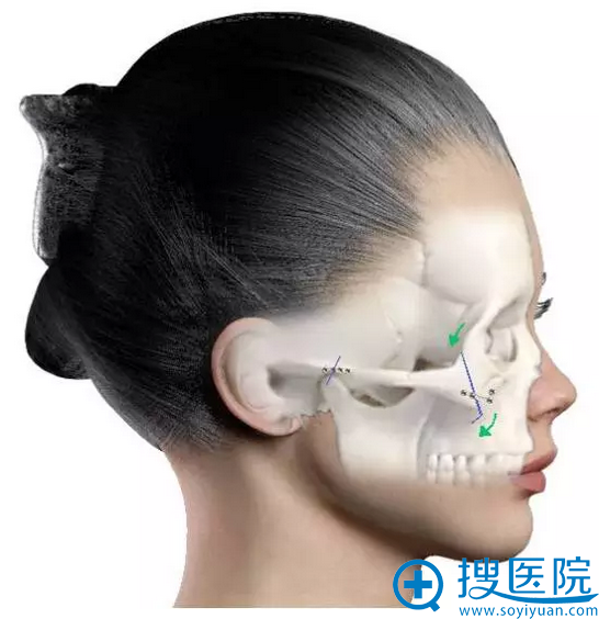 三维颧骨缩小法手术示意图 三维颧骨缩小法手术示意图
