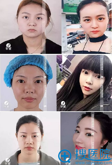 苏州华美整形美容医院塑美案例 苏州华美整形美容医院塑美案例