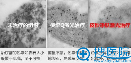北京丽都美容医院新一代7倍净斑美肤神器 激光中的法拉利