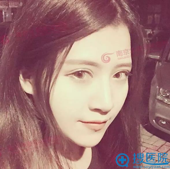 南京华美真实案例:双眼皮手术后效果 南京华美真实案例:双眼皮手术后效果