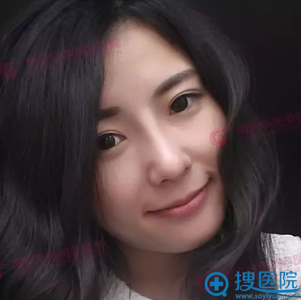 南京华美双眼皮+上眼睑提拉+开眼角术后效果 南京华美双眼皮+上眼睑提拉+开眼角术后效果