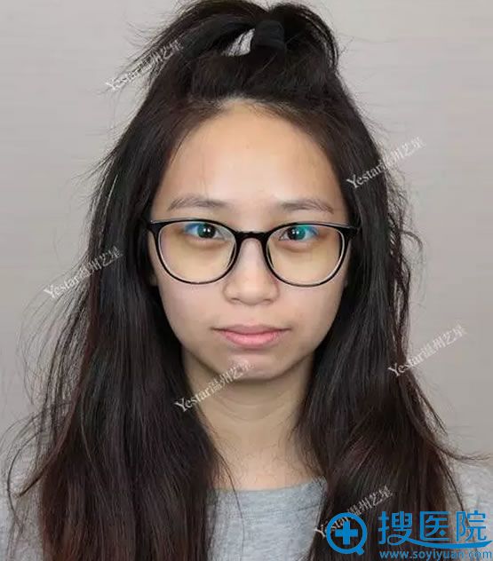 暄暄术前苦瓜脸留档照 暄暄术前苦瓜脸留档照