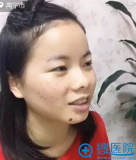 在南宁东方整形医院做蜂巢皮秒术前照 在南宁东方整形医院做蜂巢皮秒术前照