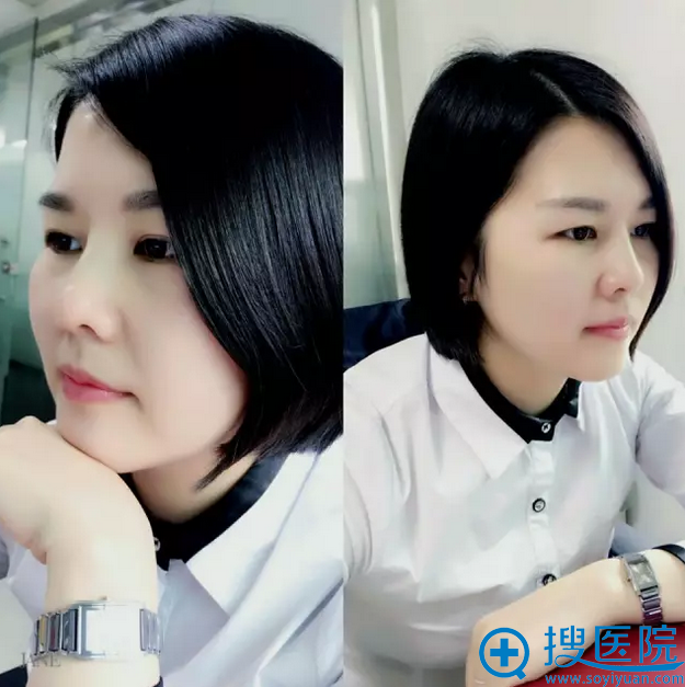 线雕隆鼻后工作照 线雕隆鼻后工作照