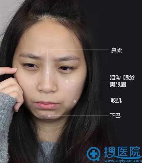 根据暄暄脸型选择玻尿酸、综合改善 根据暄暄脸型选择玻尿酸、综合改善
