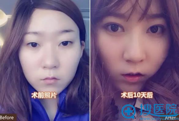 南京华美双眼皮术前术后10天对比照片 南京华美双眼皮术前术后10天对比照片