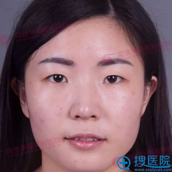 南京华美双眼皮+上眼睑提拉+开眼角术前效果 南京华美双眼皮+上眼睑提拉+开眼角术前效果