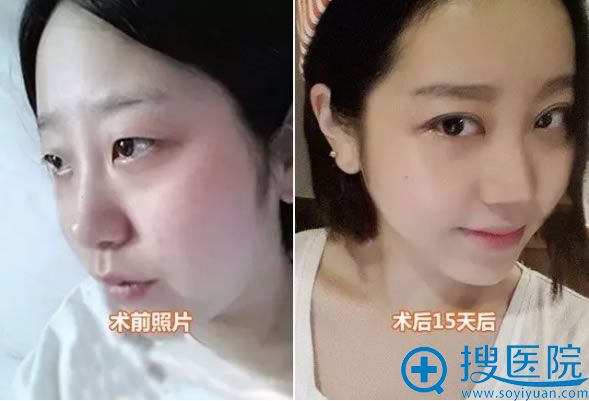 南京华美双眼皮术前术后15天对比图 南京华美双眼皮术前术后15天对比图