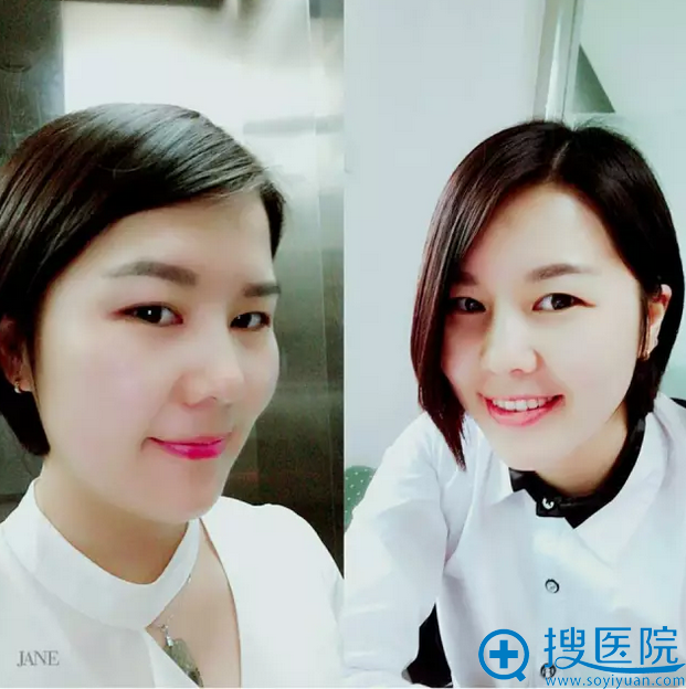 线雕隆鼻术后一周 线雕隆鼻术后一周