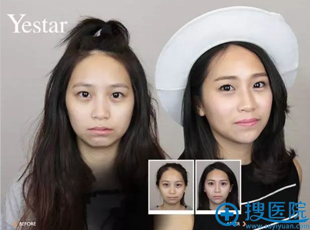 温州艺星如何用玻尿酸+让苦瓜脸变成微笑脸 温州艺星如何用玻尿酸+让苦瓜脸变成微笑脸