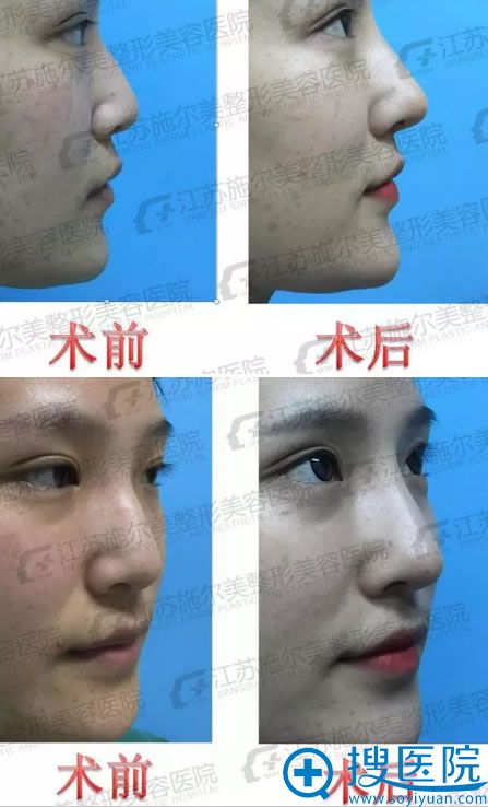 陈超教授亲手打造的鼻整形案例 陈超教授亲手打造的鼻整形案例