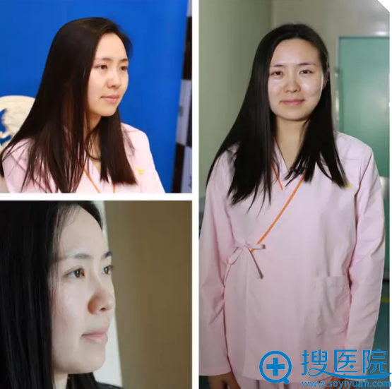 【杭州yestar案例】花3000元在杭州艺星做完双眼皮7天恢复图片