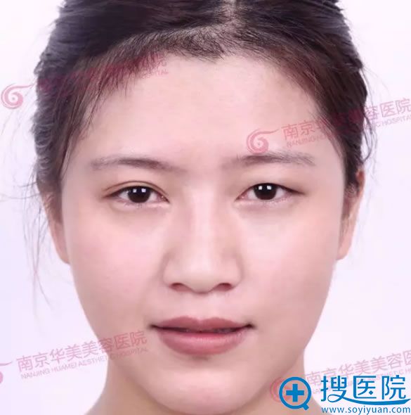 南京华美真实案例:双眼皮手术前 南京华美真实案例:双眼皮手术前