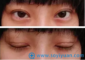 劣质双眼皮留下疤痕 劣质双眼皮留下疤痕
