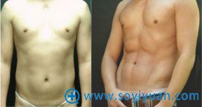 男士腹部吸脂前后对比照