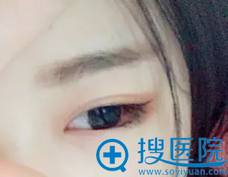 这就是价值一万八的双眼皮 这就是价值一万八的双眼皮