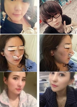 重庆华美整形医院张国强综合鼻整形修复真人案例第23天照片