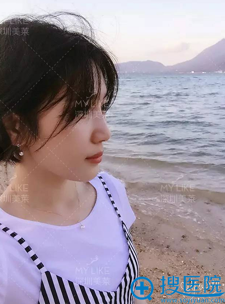 线雕隆鼻术后生活侧面照 线雕隆鼻术后生活侧面照