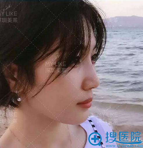 花9800元在深圳美莱整形医院找梁宇辉做完线雕隆鼻7天恢复过程