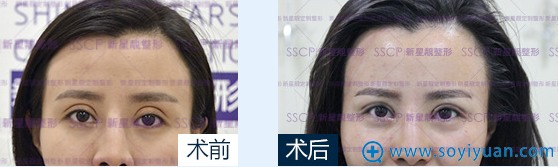 <!--<i data=20240710 data-id=15861></i>-->院长修复双眼皮案例 <!--<i data=20240710 data-id=15861></i>-->院长修复双眼皮案例