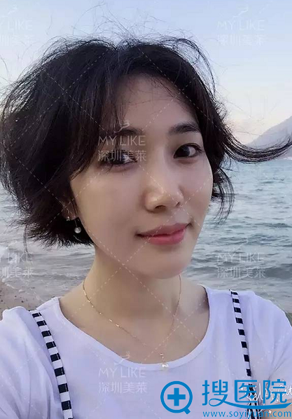 线雕隆鼻正面生活照 线雕隆鼻正面生活照