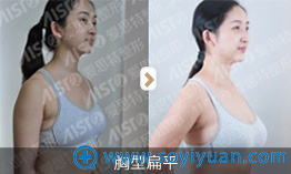 长沙爱思特胡朝辉丰胸效果对比 长沙爱思特胡朝辉丰胸效果对比