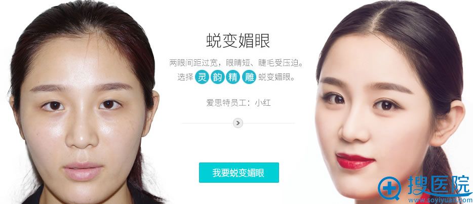 长沙爱思特张娇娇双眼皮案例 长沙爱思特张娇娇双眼皮案例